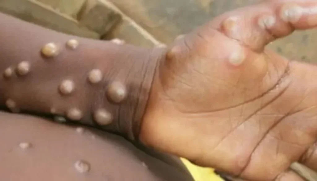 OMS: viruela del mono es una emergencia sanitaria mundial