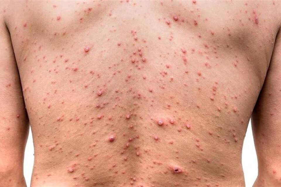 Venezuela anunció que fortalecerá medidas por viruela del mono