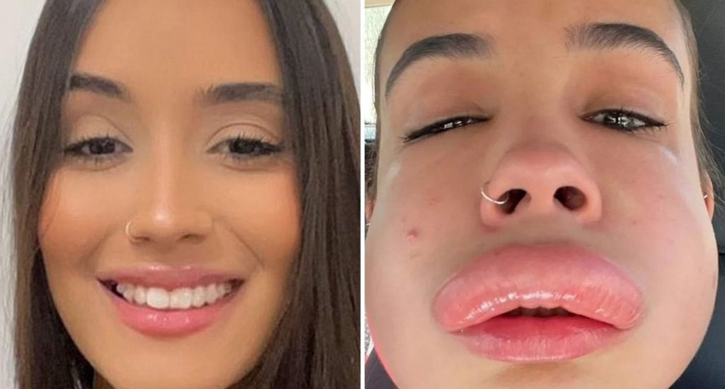 Joven casi pierde la vida tras sesión fallida de relleno de labios